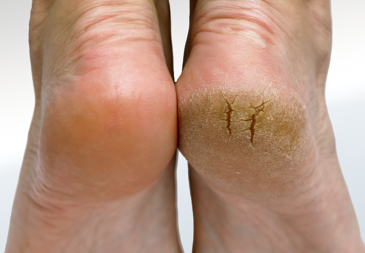 Acide glycolique pour les pieds