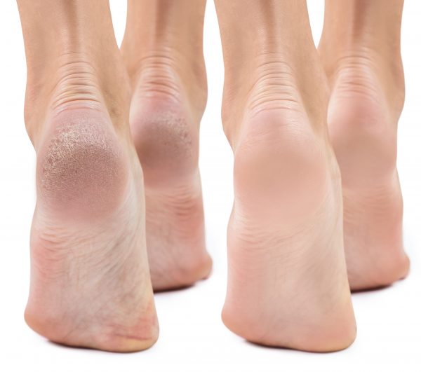 Acide glycolique pour les pieds